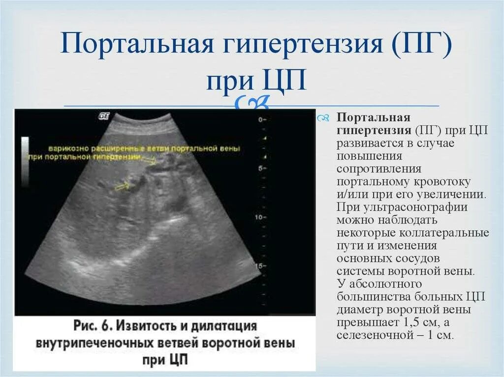 Печень увеличена на узи причины у взрослых. Расширение воротной вены на узи печени. признаки портальной гипертензии на узи. синдрома портальной гипертензии (расширение портальной вены) узи. узи критерии портальной гипертензии.