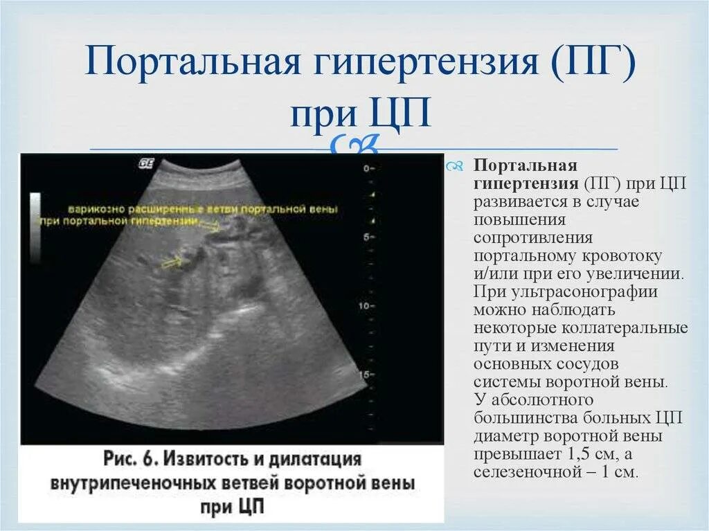 Признаки портальной гипертензии на УЗИ. УЗИ критерии портальной гипертензии. Расширение воротной вены на УЗИ печени. Воротная Вена при циррозе печени УЗИ. Печень расширены вены