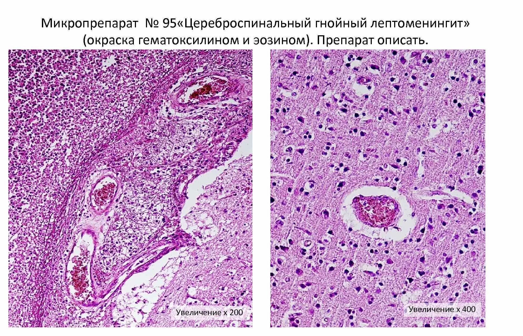 Гнойный менингоэнцефалит гистология. Гнойный менингит микропрепарат патанатомия. Гнойный менингококковый лептоменингит микропрепарат. Церебральный Гнойный менингит микропрепарат. Описание гнойного