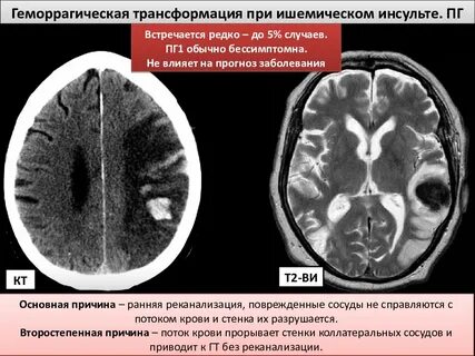 Ишемический инсульт и инсульт разница