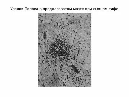 Вшивый сыпной тиф