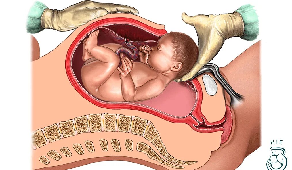 Рождение ребенка кесарево сечение. Родоразрешение кесарево сечение. Роды при кесаревом сечении. Техника кесарева сечения
