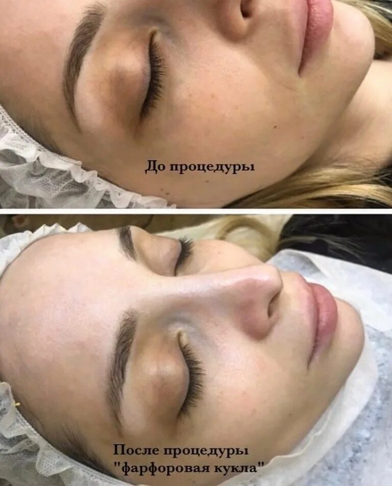 Косметология лица до и после. Процедура фарфоровая кукла до и после лицо. Процедура фарфоровая кукла до и после лицо. Фарфоровая кукла процедура. Фарфоровая кукла пилинг для лица.