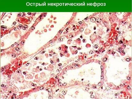 Нефрит и нефроз