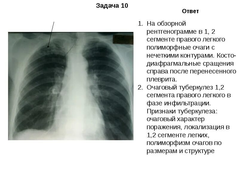 Очаг гона при туберкулезе. Единичный петрификат. Первичный туберкулезный комплекс на рентгенограмме. Петрификаты в легких микропрепарат. Первичный очаг (первичный аффект) микропрепарат.