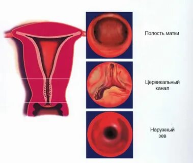 Пролиферация цервикальный канал