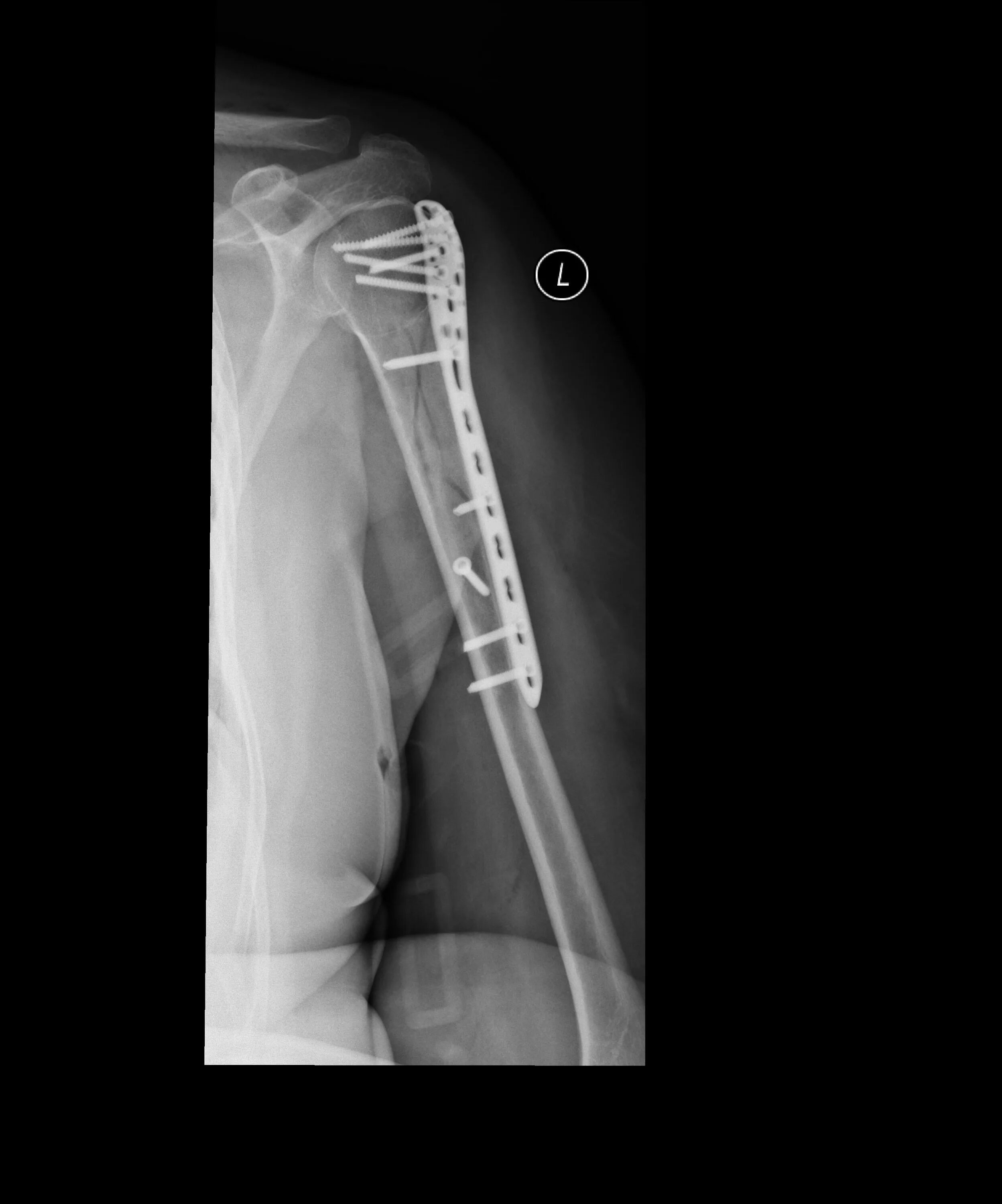 Чрескостный остеосинтез проксимального отдела плеча. Перелом хирургической шейки плечевой кости остеосинтез. Остеосинтез при переломе хирургической шейки плечевой кости. Остеосинтез плечевого сустава рентген. Погружной чрескостный остеосинтез.