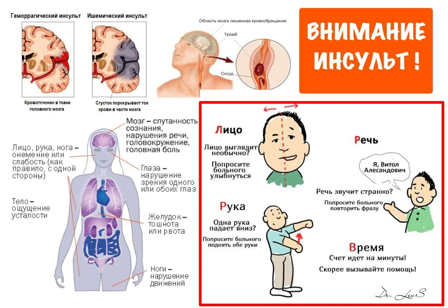 Инсульт удар: найдено 83 изображений