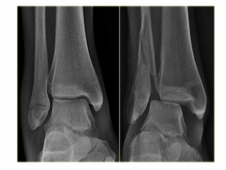 Перелом лодыжки форум вумен. Пронационный перелом лодыжки. Перелом наружной лодыжки рентген. Перелом Дюпюитрена лодыжки. Перелом Дюпюитрена рентген.