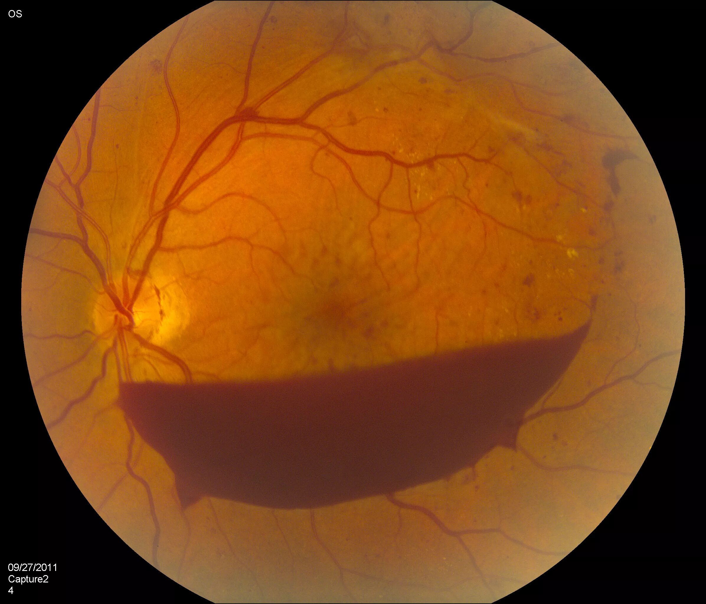 Диабетическая ретинопатия ретинопатия. Диабетическая ретинопатия отслойка сетчатки. Отслойка сетчатки глазное дно. Диабетическая ретинопатия глазное дно.