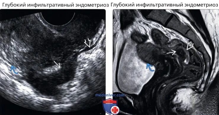 Утолщение стенки миометрия. Утолщение стенки миометрия