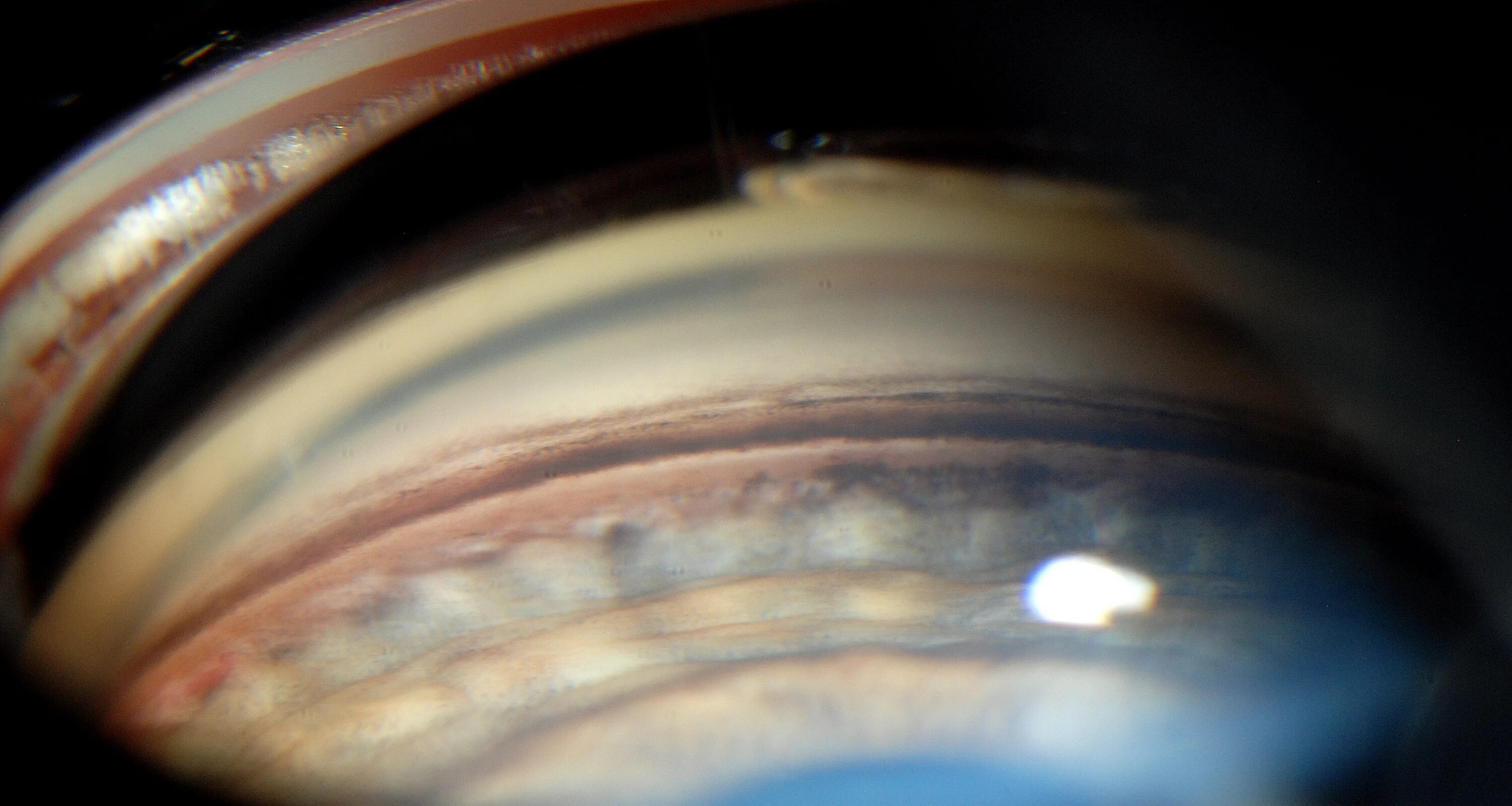 Синдром дисперсии. Синдромы при заболеваниях пищеварительной системы. Диспепсия причины. Синдром пигментной дисперсии глаза. Синдром пигментной дисперсии глаза.