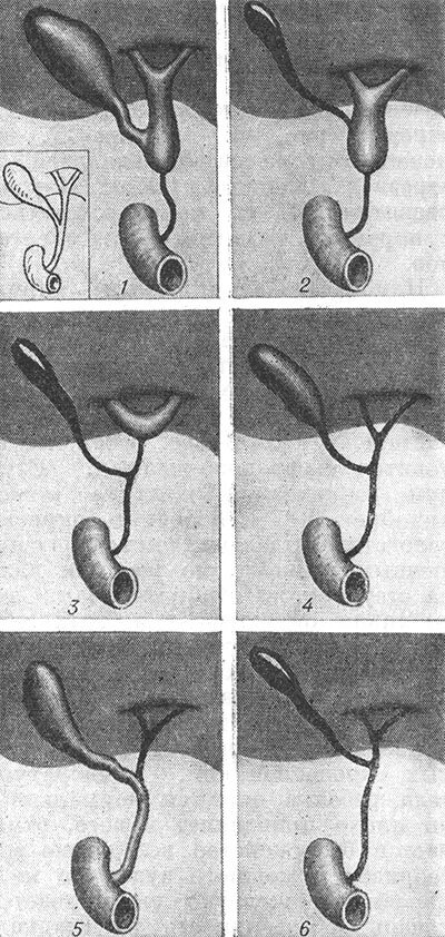 атрезия желчевыводящих путей у новорожденных