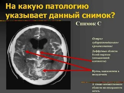 Субарахноидальное пространство выражено неравномерно