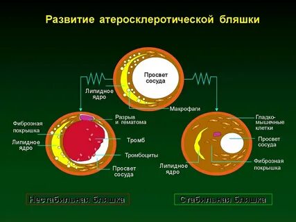 Атеросклеротическая бляшка