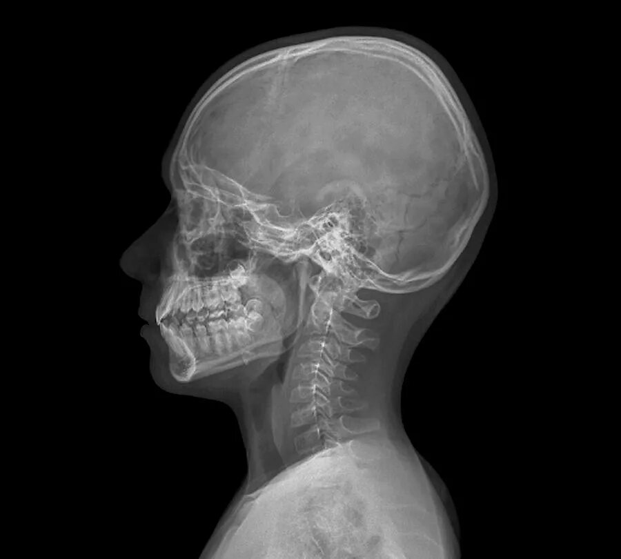Трещина в голове. Рентгеновский снимок черепа. Рентгенография черепа в боковой проекции.