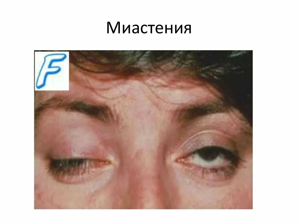 миастения гравис symptoms.