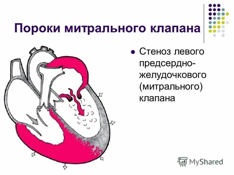 Митральный аортальный стеноз. Порок митрального клапана сердца. Пороки митрального клапана стеноз. Порог митрального клапана. Пороки сердца митральный стеноз.