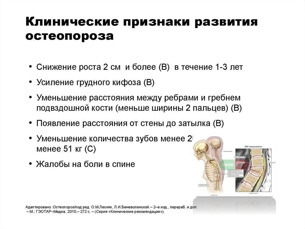 Клинические симптомы остеопороза. Остеопороз. Клинико-морфологические проявления.. Клинические проявления остеопороза у женщин. Менопаузальный остеопороз симптомы.