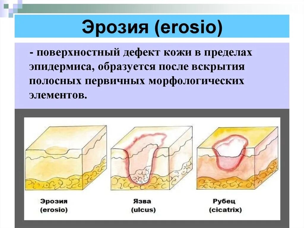 Слизистые покровы или гладкая поверхность мелкие. Эрозия вторичный элемент.