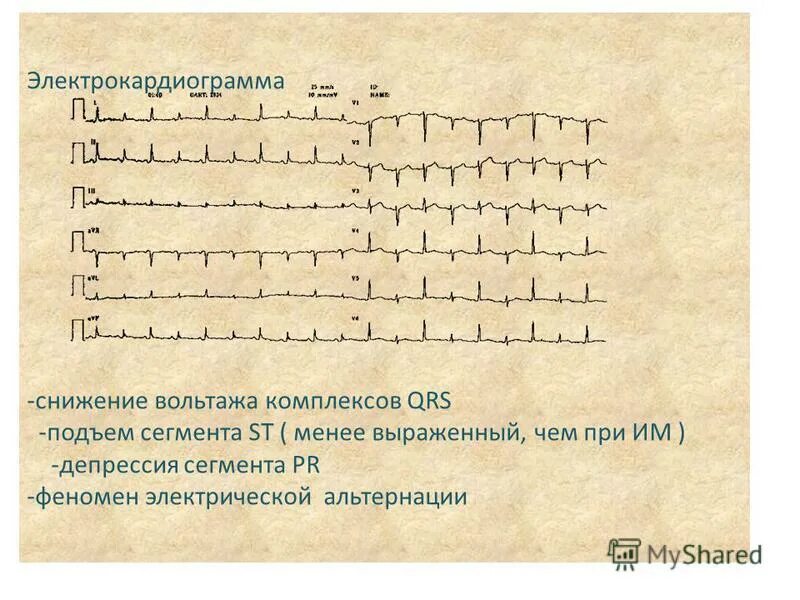 альтернация комплекса qrs на экг. альтернация т-зубцов. альтернация комплекса qrs. экг электрическая альтернация комплексов. альтернация qrs на экг.
