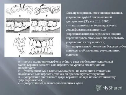 Высота прикуса