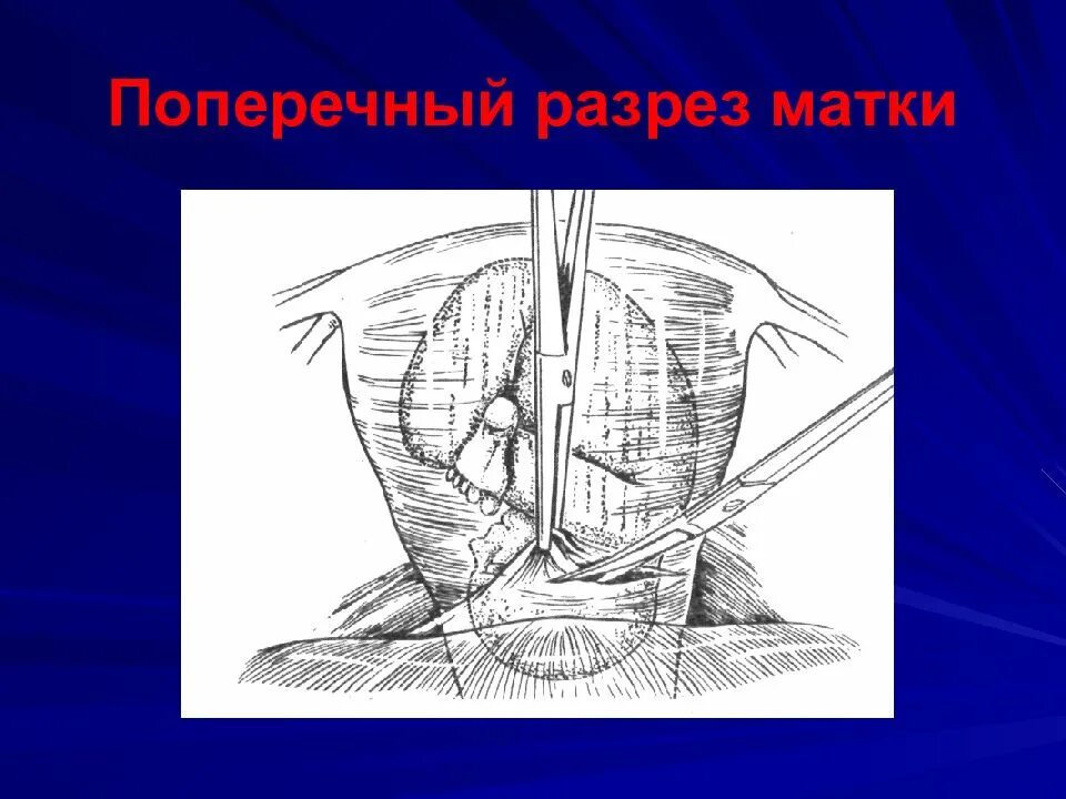 Операция сечения