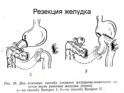 Удаление желудка сколько живут