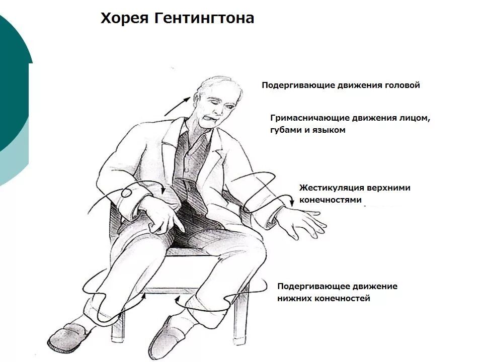 Хорь болезнь. Синдром Хорея Хантингтона. Хорея Гентингтона клинические формы. Болезнь Гентингтона симптомы. Хорея Гентингтона клинические проявления.