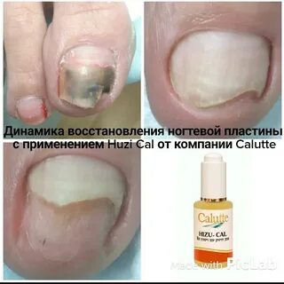 Лосьон стоп онихолизис