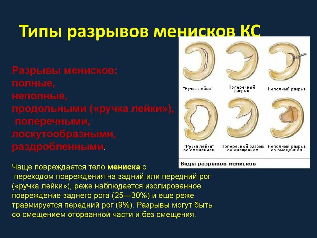 Дегенерация мениска. Разрыва заднего рога латерального мениска по типу "ручки лейки". Разрыв мениска типа ручка лейки. Разрыва заднего рога медиального мениска ( повреждение Тип 3a. Повреждение мениска коленного сустава классификация Stoller.