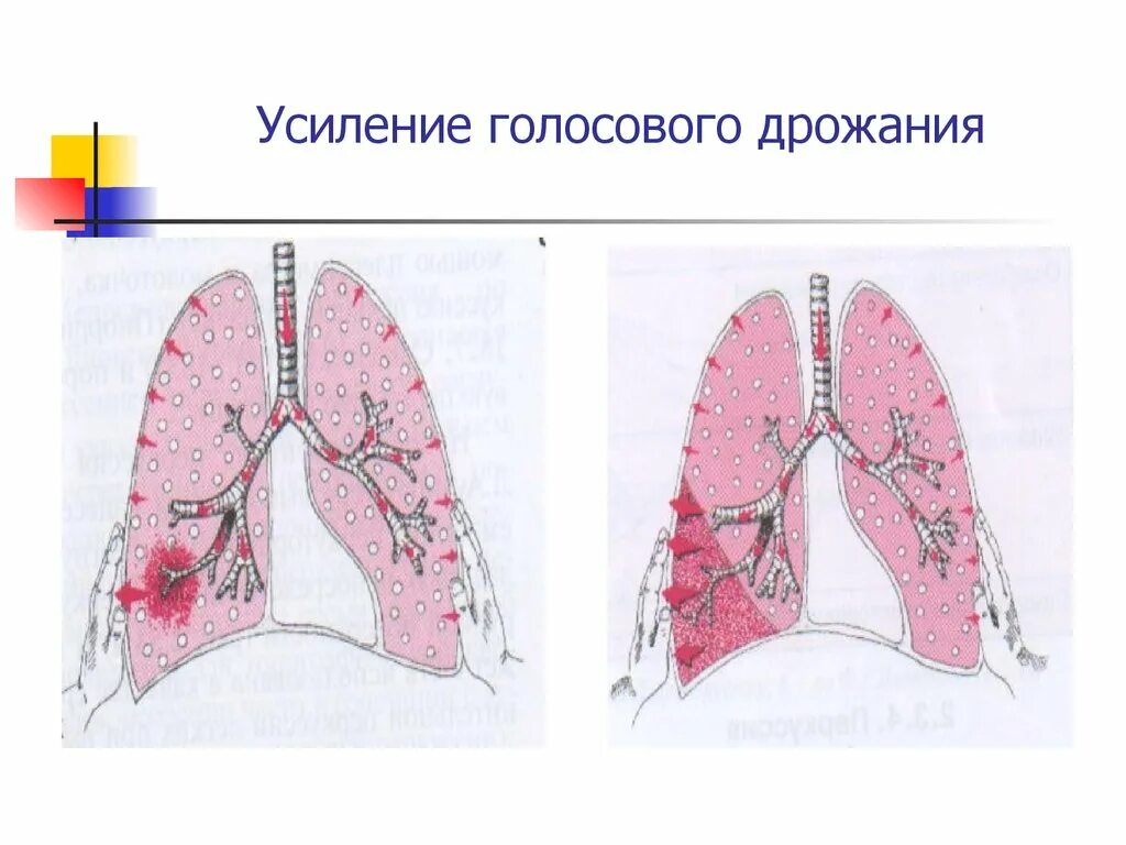 Усиленное голосовое дрожание. Осилини галосовая дражания. Усиление голосового дрожания. Усиление и ослабление голосового дрожания. Пальпация: усиление голосового дрожания.