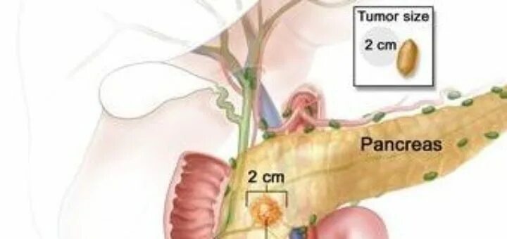 4 стадия поджелудочной железы сколько живут. Опухоли поджелудочной железы 4 стадии. Саркома поджелудочной железы 4 стадии.