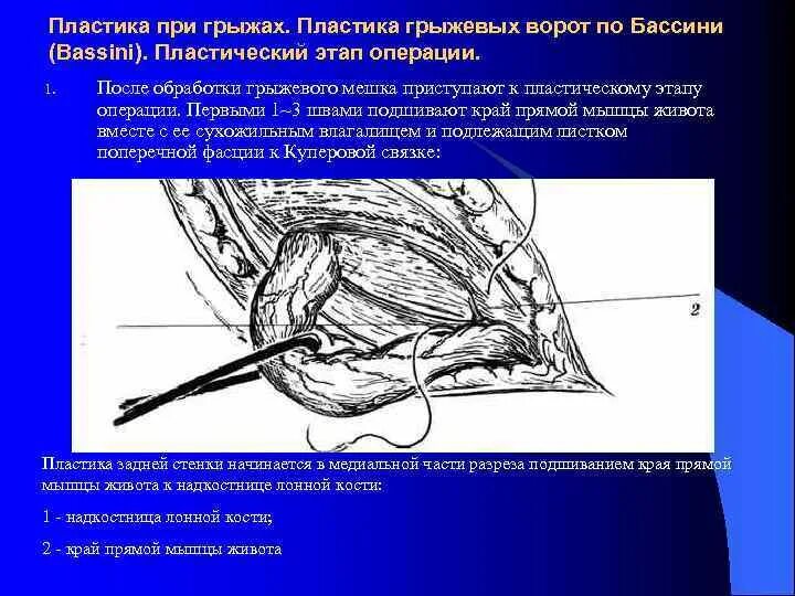 Ущемленная бедренная грыжа. Бассини пластика паховой грыжи. Операция грыжи по Бассини. Бедренная грыжа по Бассини.