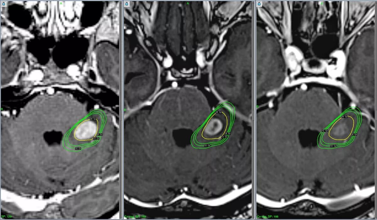 Метастазы меланомы в головной мозг кт. Метастазы меланомы в головной мозг мрт.