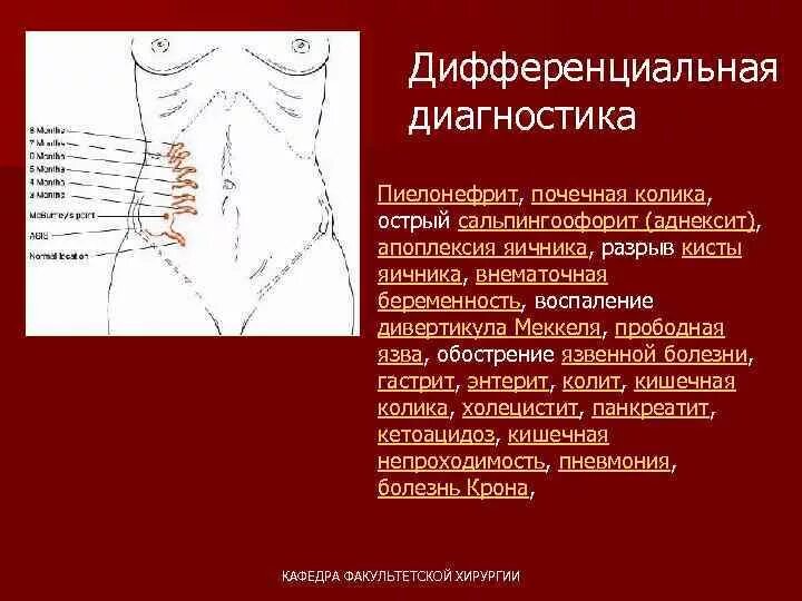 Колики аппендицит. Диф диагностика острого аппендицита. Острый аппендицит Факультетская хирургия. Дифференциальный диагноз почечной колики. Диагностика острого аппендицита хирургия.