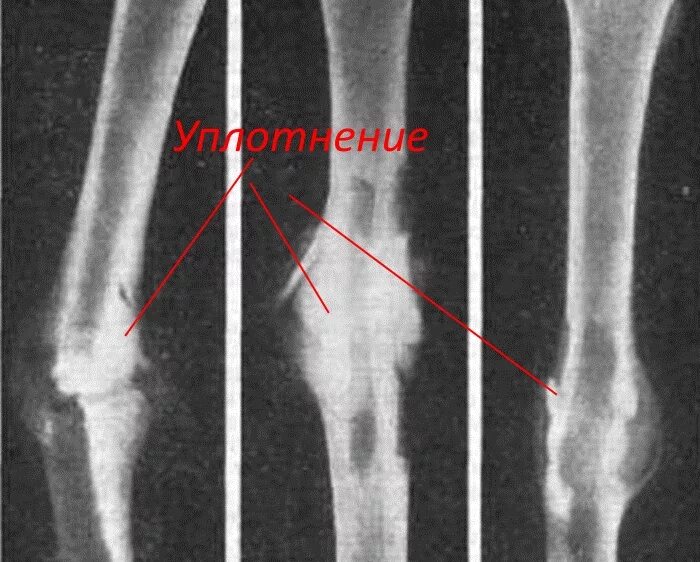 Почему болит кость после перелома. Костная мозоль при переломе.берцовой кости. Остеосклероз бедренной кости рентген. Костная мозоль после перелома большеберцовой кости на рентгене. Сросшийся перелом бедренной кости рентген.
