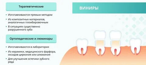 Виниры прямой метод
