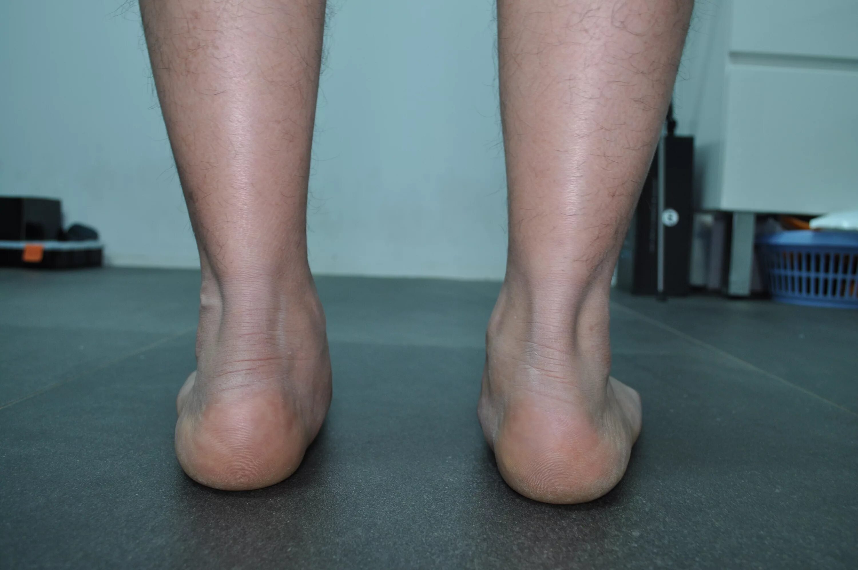 Плоскостопие на одной ноге берут ли. Паралитическое плоскостопие. Третья степень плоскостопия.