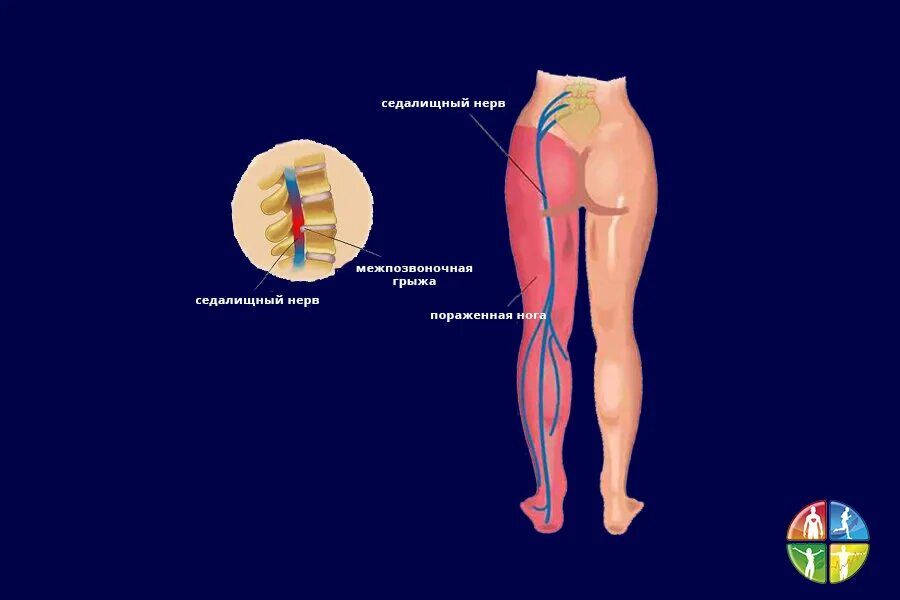 Ишиас - защемление седалищного нерва. Седалищный нерв схема расположения. Нерв в ягодице. Седалищный нерв правая ягодица