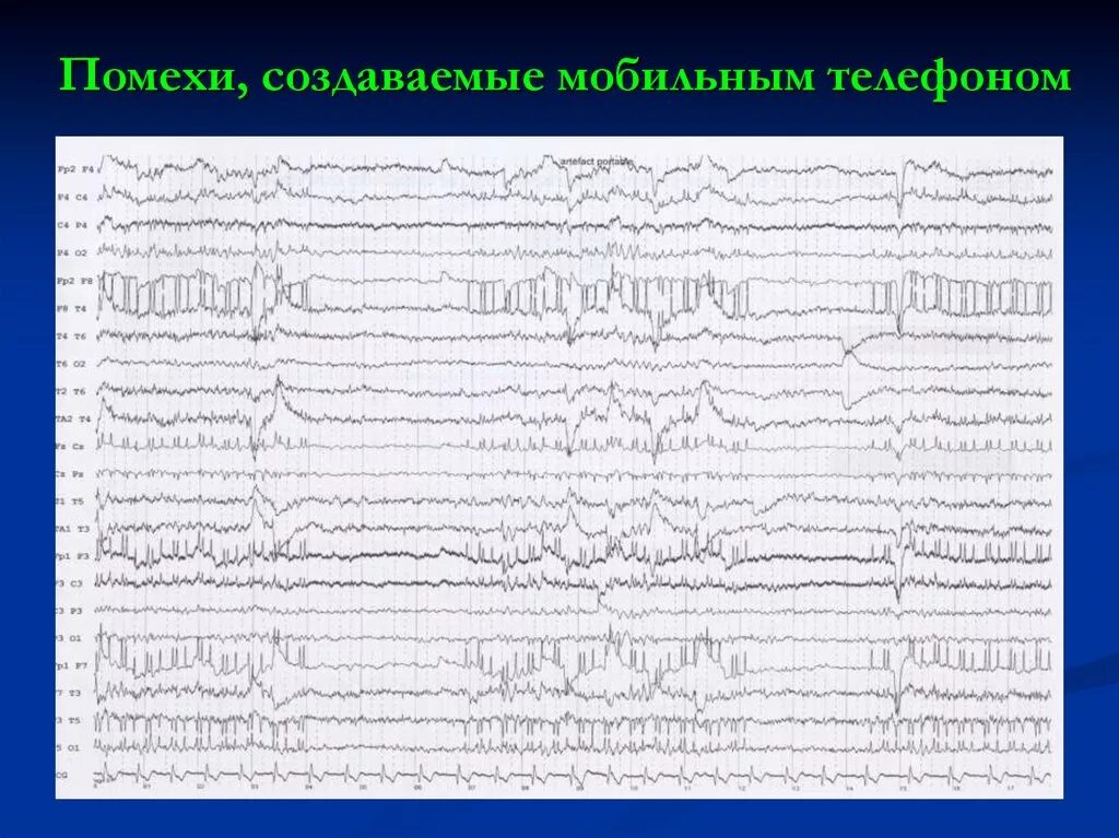 Артефакты на экг. Артефакты на кардиограмме. Кожно гальванические артефакты на ээг. Артефакт от экг на ээг. Артефакты экг наводка.
