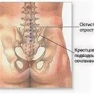 Артрит крестцово подвздошного сочленения. Сакроилеит крестцово-подвздошного сочленения снимки. артроз крестцово-подвздошных сочленений.