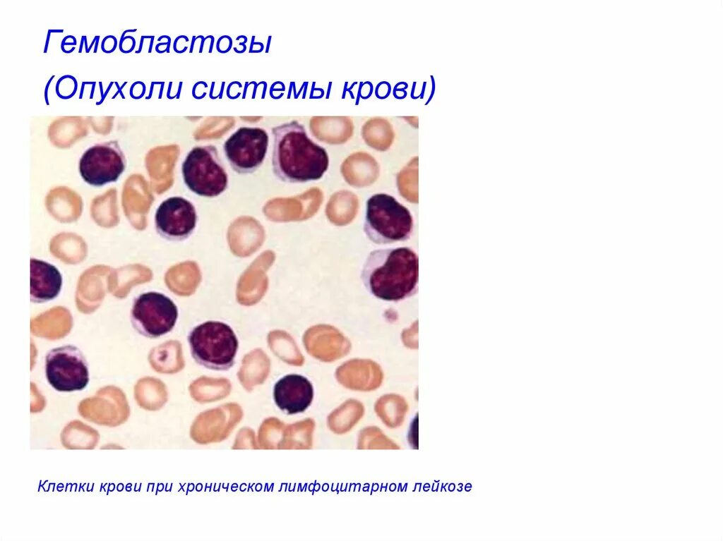Опухоли системы крови патанатомия. Гемобластозы классификация патанатомия. Опухоли системы крови (гемобластозы).. Острый лимфобластный лейкоз мазок.