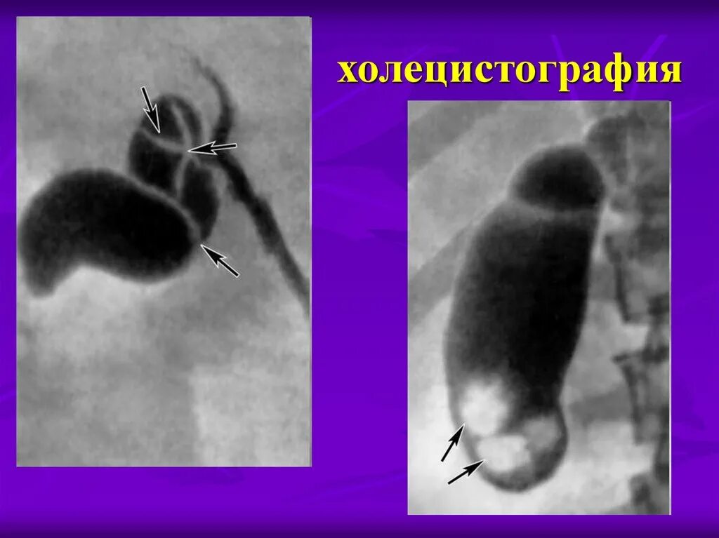 Пероральная холецистография. Холецистография полип. Ультразвуковая динамическая холецистография. Холецистография при холецистите. Холеграфия желчного пузыря.