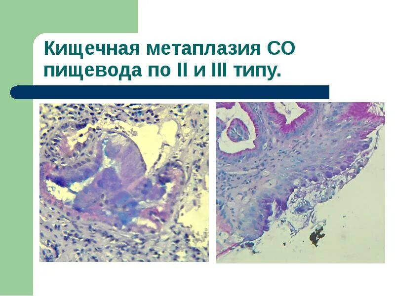 Желудочная метаплазия пищевода. Кишечная метаплазия пищевода. Метаплазия 12 перстной кишки.