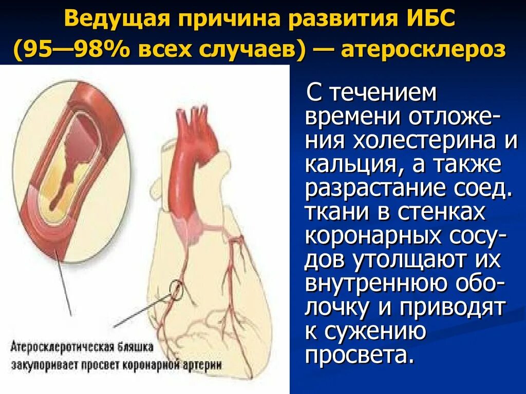 Ибс атеросклеротическая болезнь. Ибс атеросклеротическая болезнь сердца. факторы развития атеросклероза. развитию атеросклероза и ибс способствуют:.