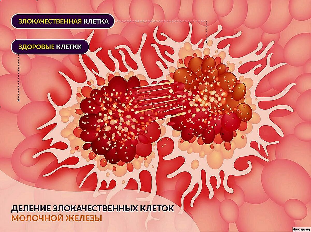 Гормонозависимая опухоль молочной железы. Раковые клетки молочной железы. гормонозависимые раковые опухоли. деление злокачественных клеток. клетки при злокачественной опухоли.