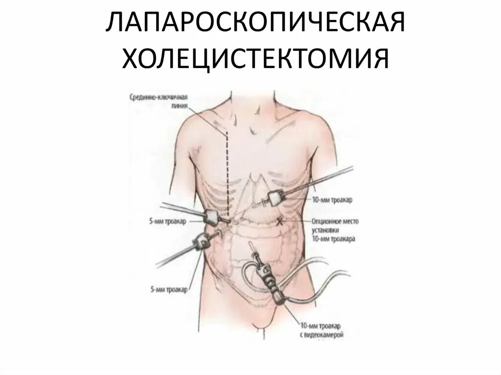 Операция по удалению желчного пузыря анализы. Лапароскопическая холецистэктомия схема операции. Операции лапароскопия холецистэктомия. Лапароскопия желчного пузыря разрезы. Лапароскопическая холецистэктомия схема вмешательства.