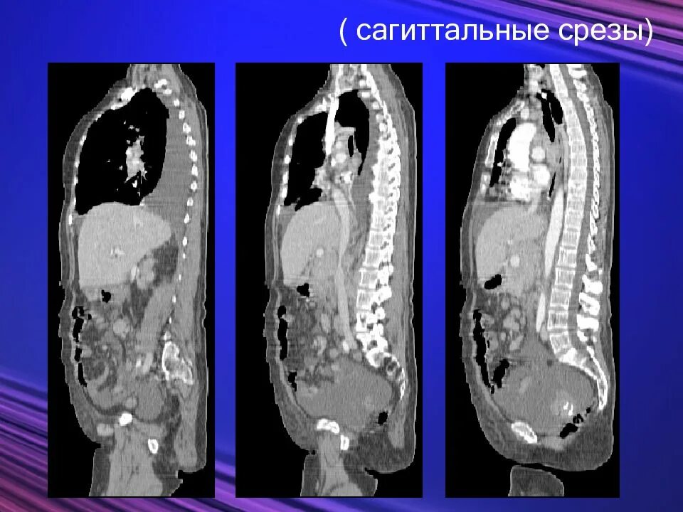 Диагностический срез. Кт брюшной полости аксиальный срез. лимфогранулематоз мрт. срезы кт. аксиальный срез кт.