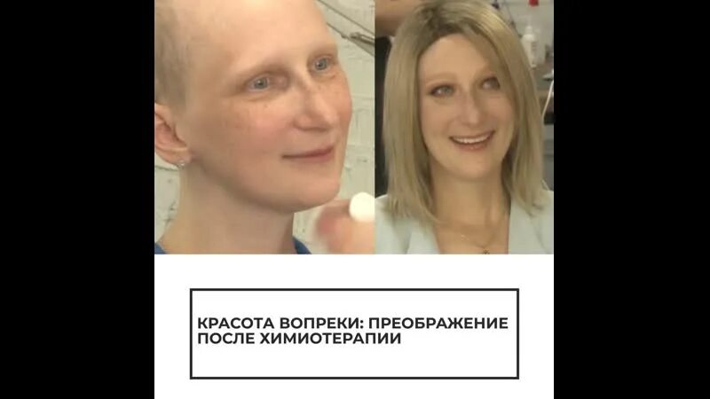 Нос после химиотерапии. Брови после химиотерапии. Отрастают ли волосы после химиотерапии. Наращивание волос после химиотерапии. Выпадение волос после химиотерапии.